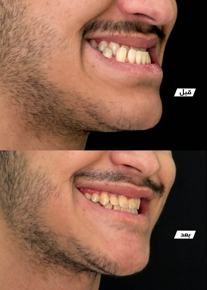 حالة قبل وبعد رقم 7 - جراحة تجميل