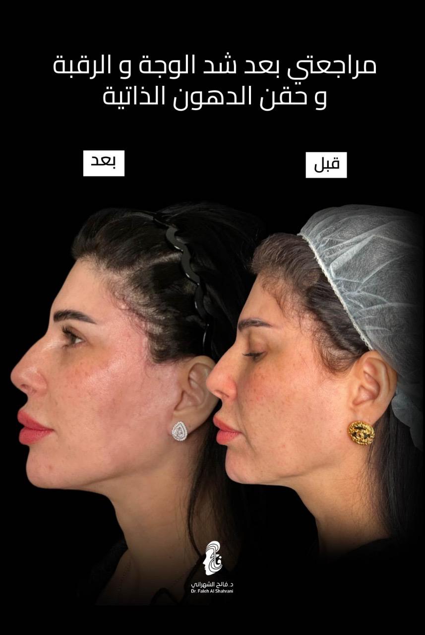 حالة قبل وبعد رقم 3 - جراحة تجميل