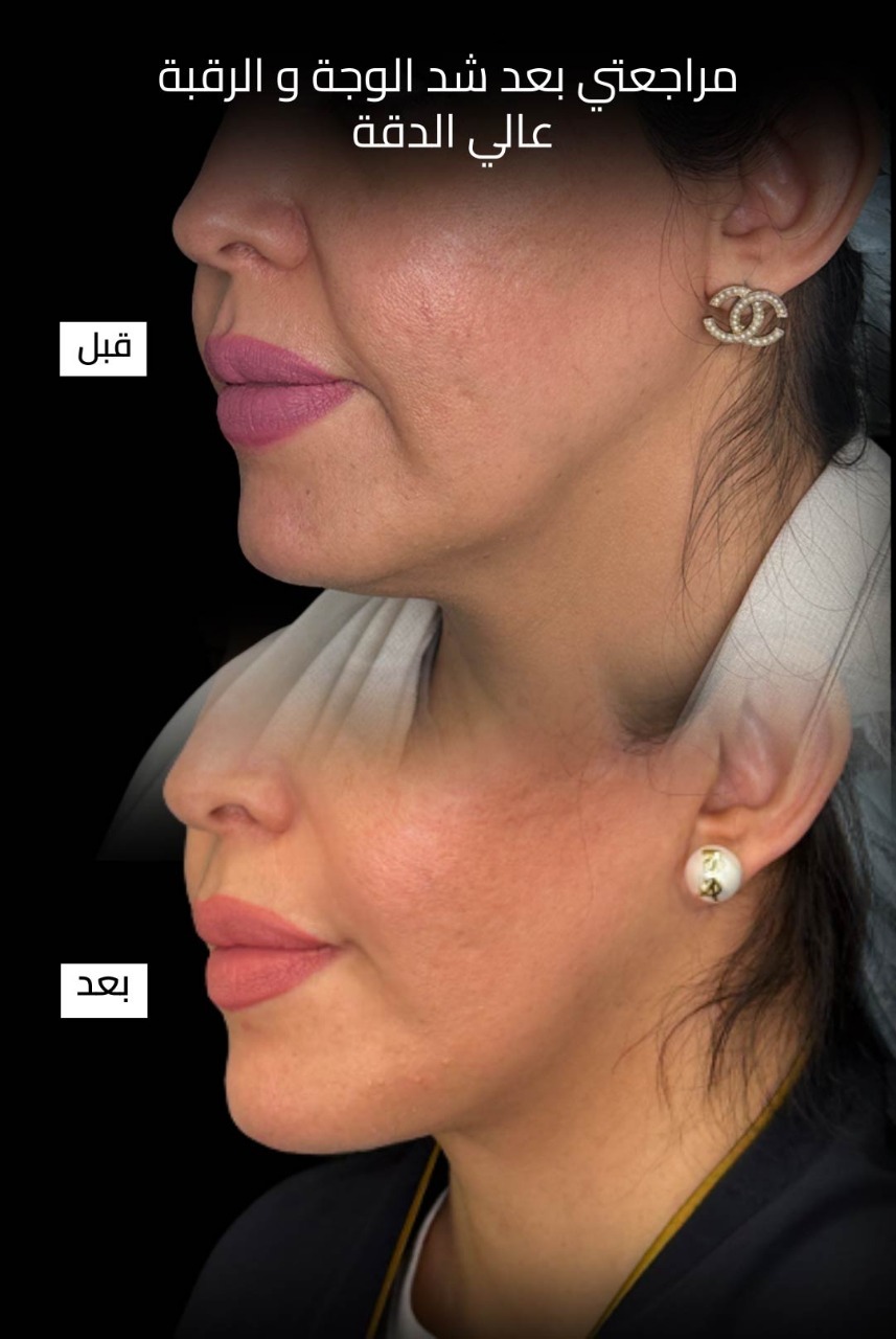 حالة قبل وبعد رقم 5 - جراحة تجميل
