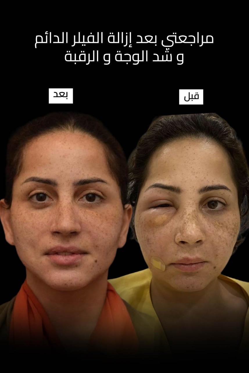 حالة قبل وبعد رقم 6 - جراحة تجميل