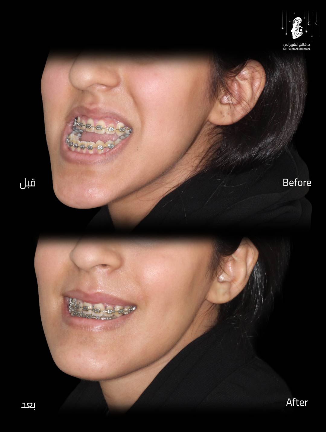 حالة قبل وبعد رقم 15 - جراحة تجميل