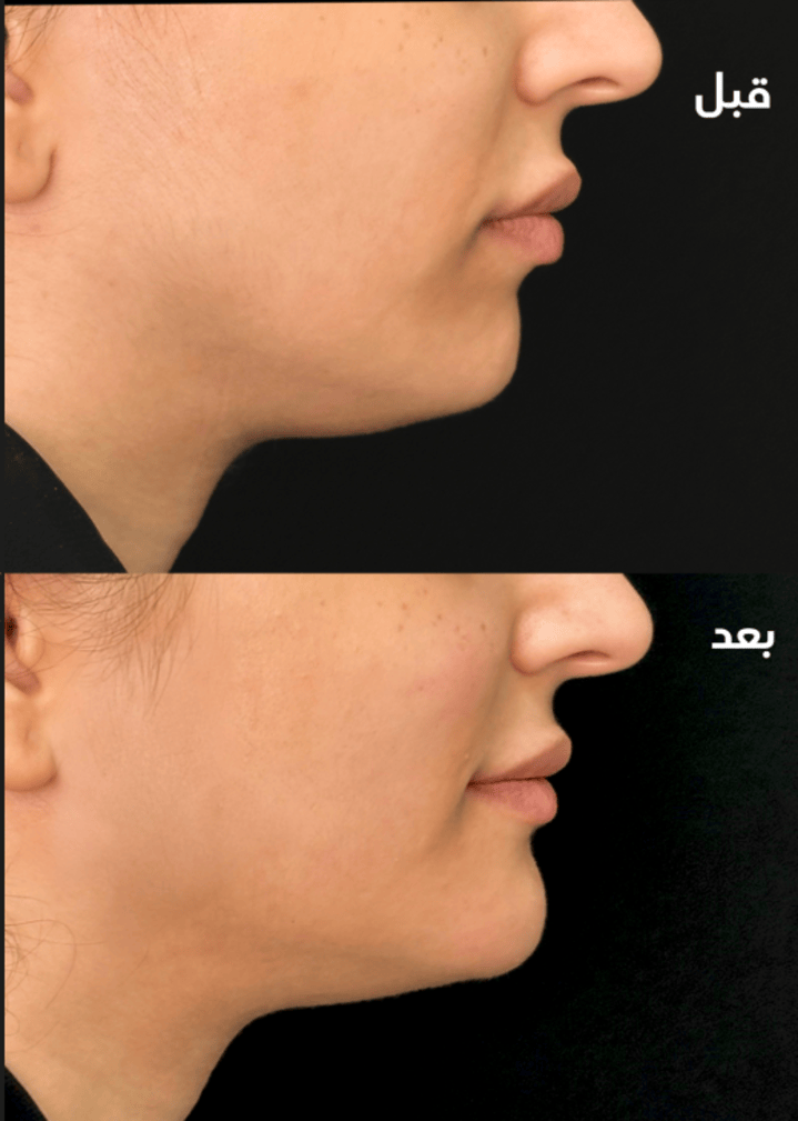 حالة قبل وبعد رقم 8 - جراحة تجميل