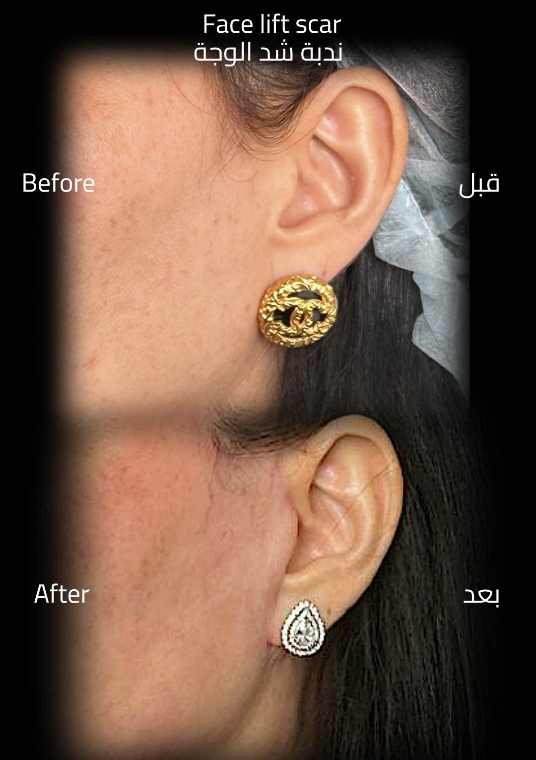حالة قبل وبعد رقم 17 - جراحة تجميل