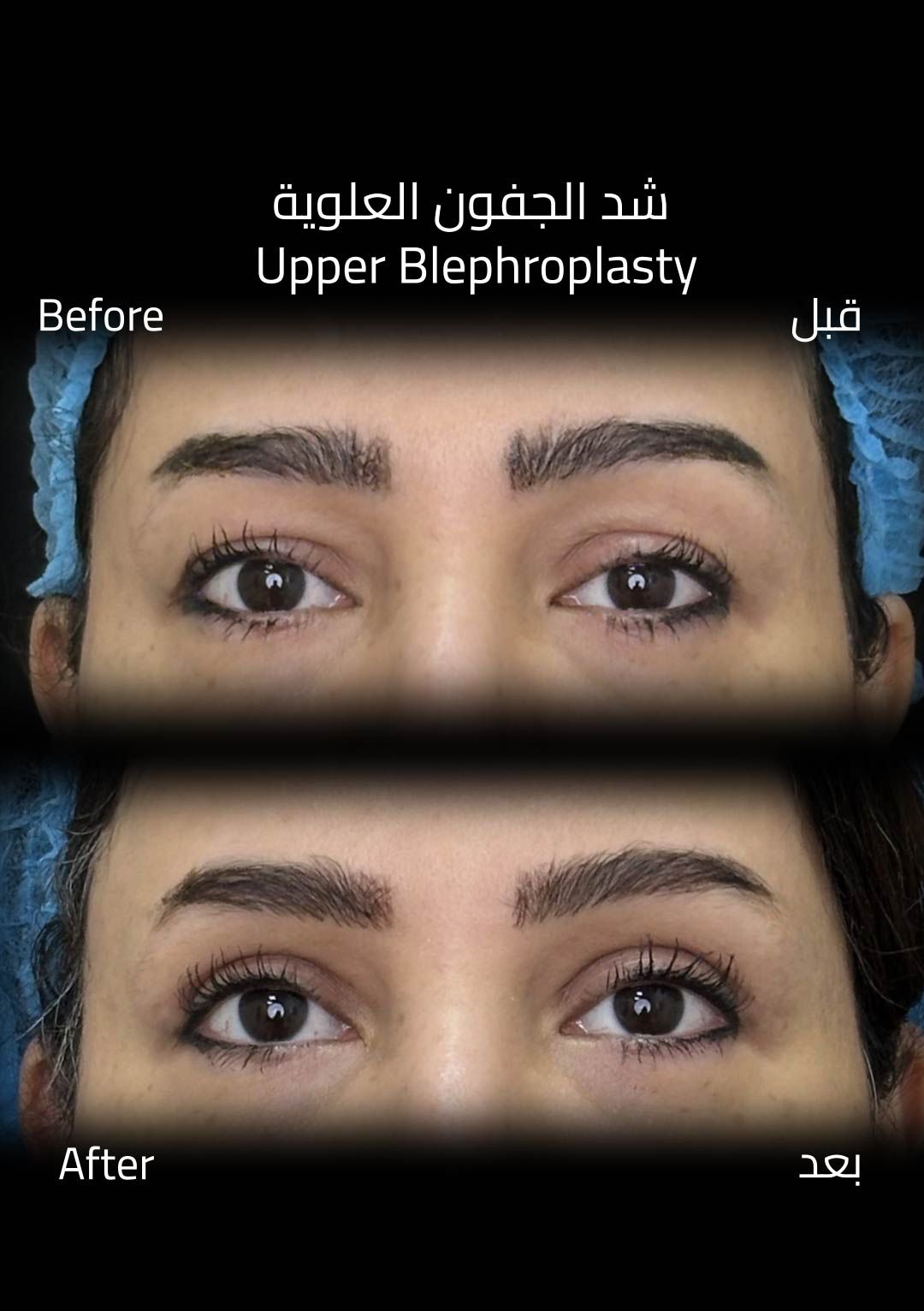 حالة قبل وبعد رقم 18 - جراحة تجميل