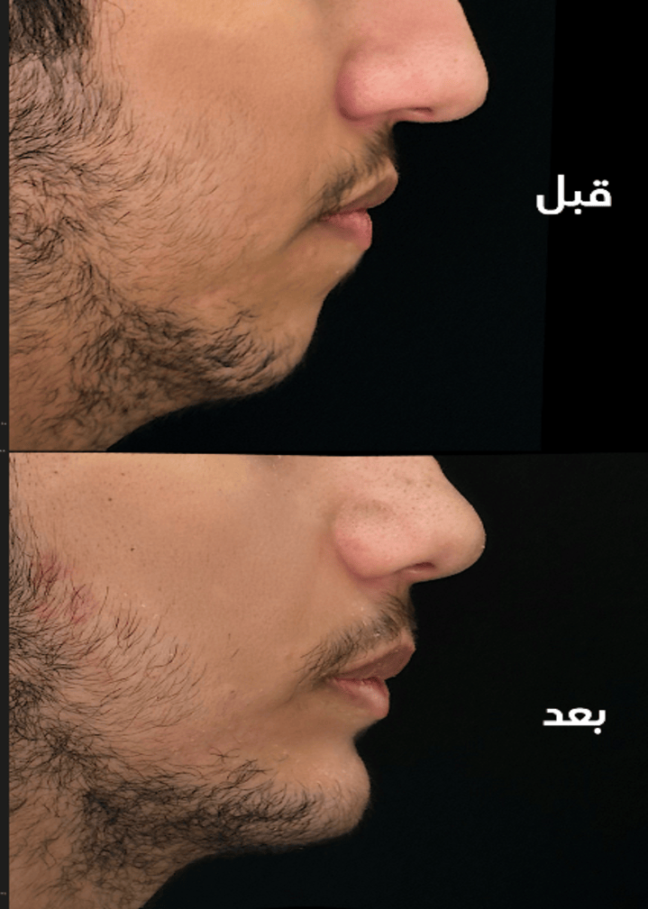 حالة قبل وبعد رقم 9 - جراحة تجميل