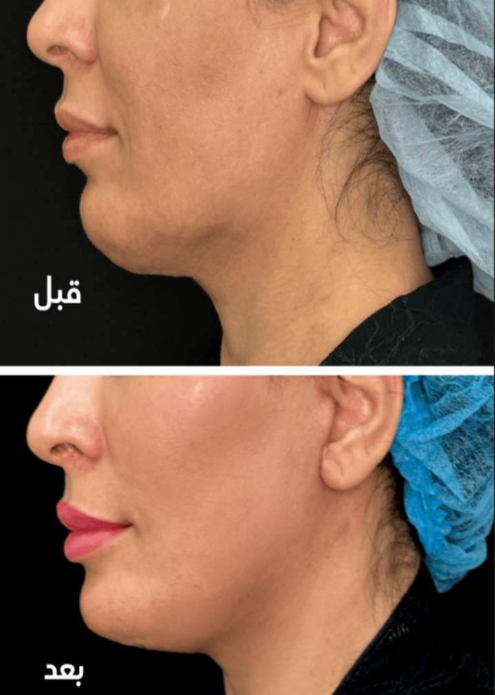 حالة قبل وبعد رقم 10 - جراحة تجميل