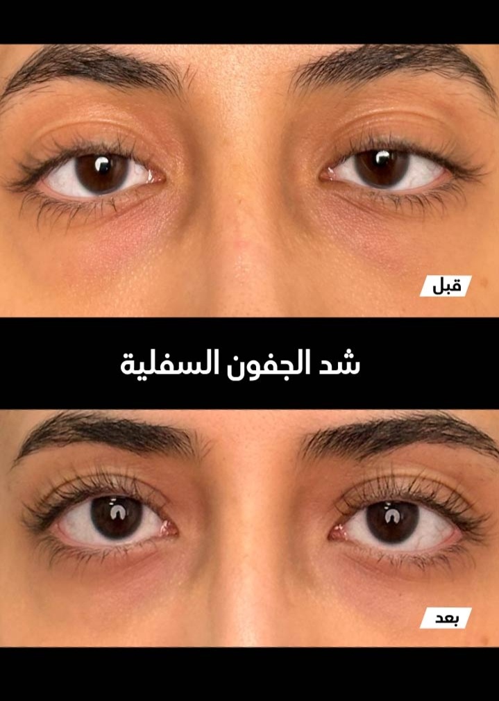 حالة قبل وبعد رقم 11 - جراحة تجميل