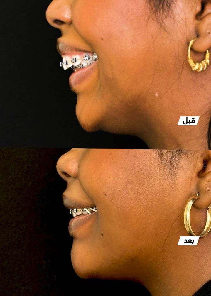حالة قبل وبعد رقم 12 - جراحة تجميل