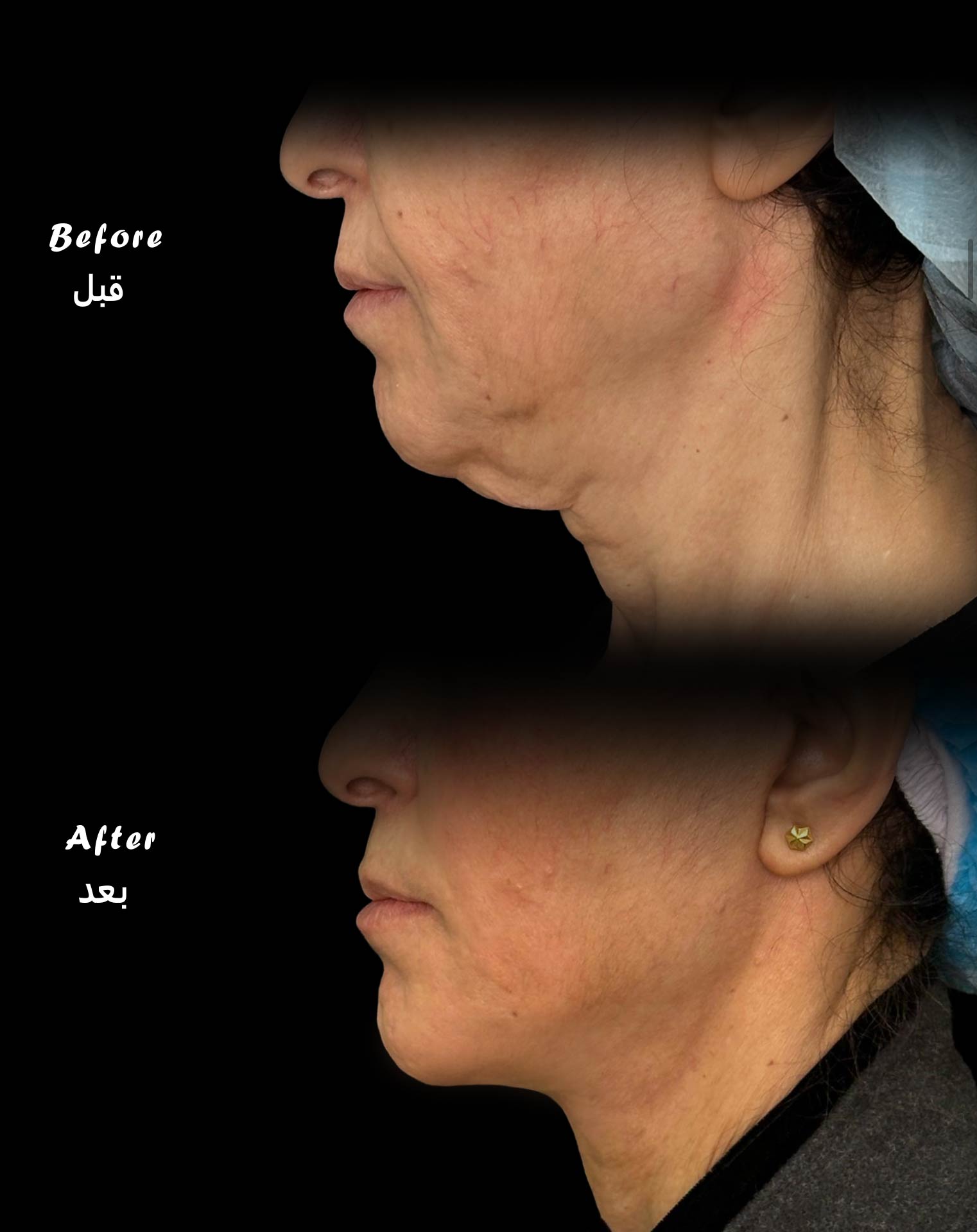 حالة قبل وبعد رقم 19 - جراحة تجميل
