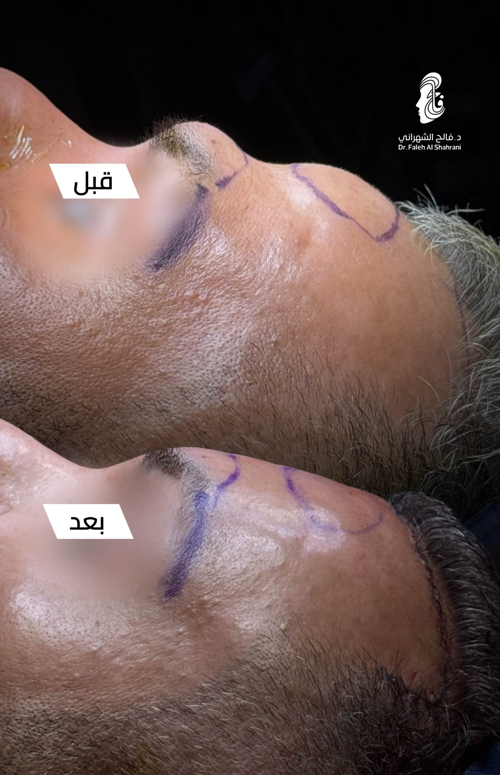 حالة قبل وبعد رقم 23 - جراحة تجميل