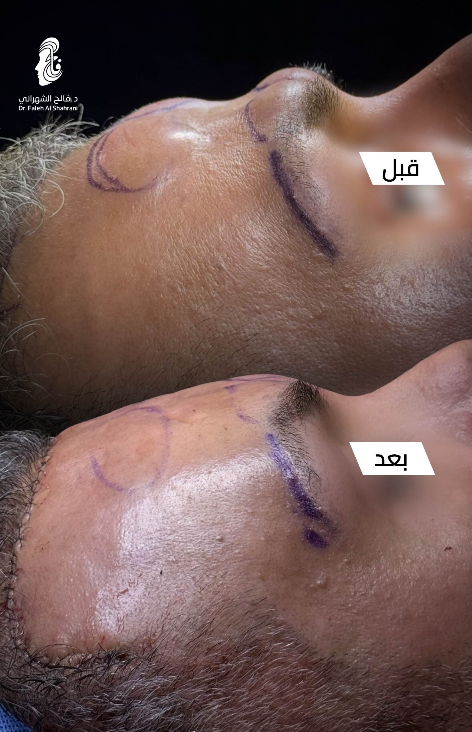 حالة قبل وبعد رقم 22 - جراحة تجميل