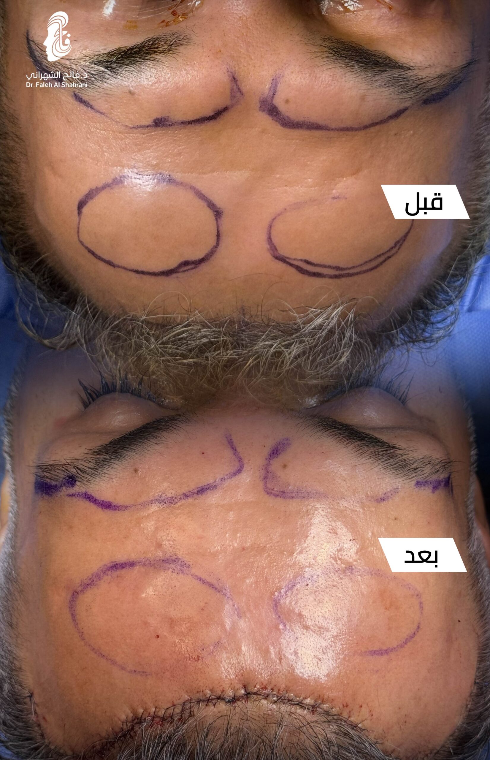 حالة قبل وبعد رقم 21 - جراحة تجميل
