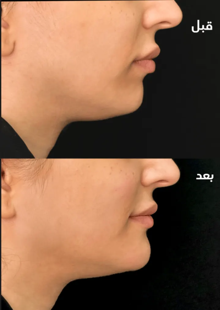 حالة قبل وبعد رقم 8 - جراحة تجميل