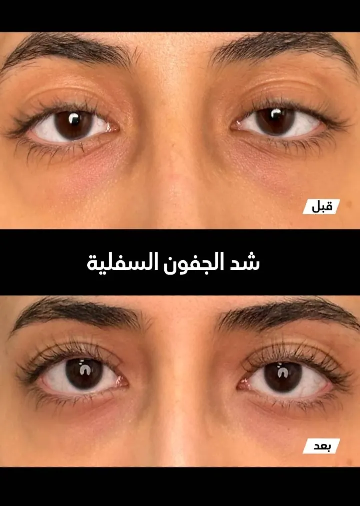 حالة قبل وبعد رقم 11 - جراحة تجميل