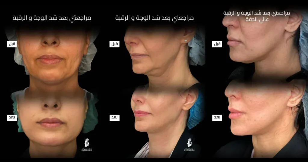 نتائج قبل وبعد شد الوجه في الرياض لثلاث حالات حقيقية مع د. فالح الشهراني